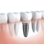 Interesujące fakty na temat implantów stomatologicznych