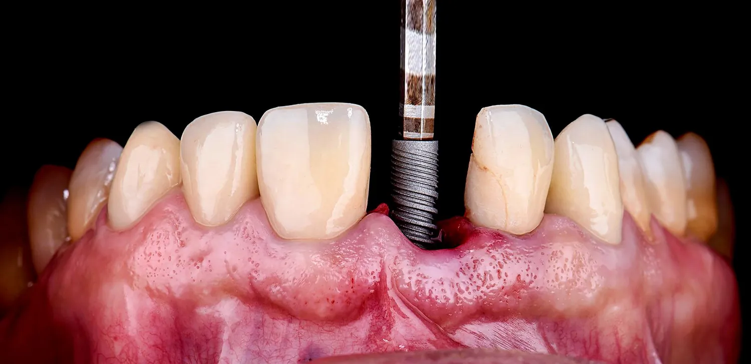 co-nalezy-wiedziec-przed-wyborem-implantu-zeba-1