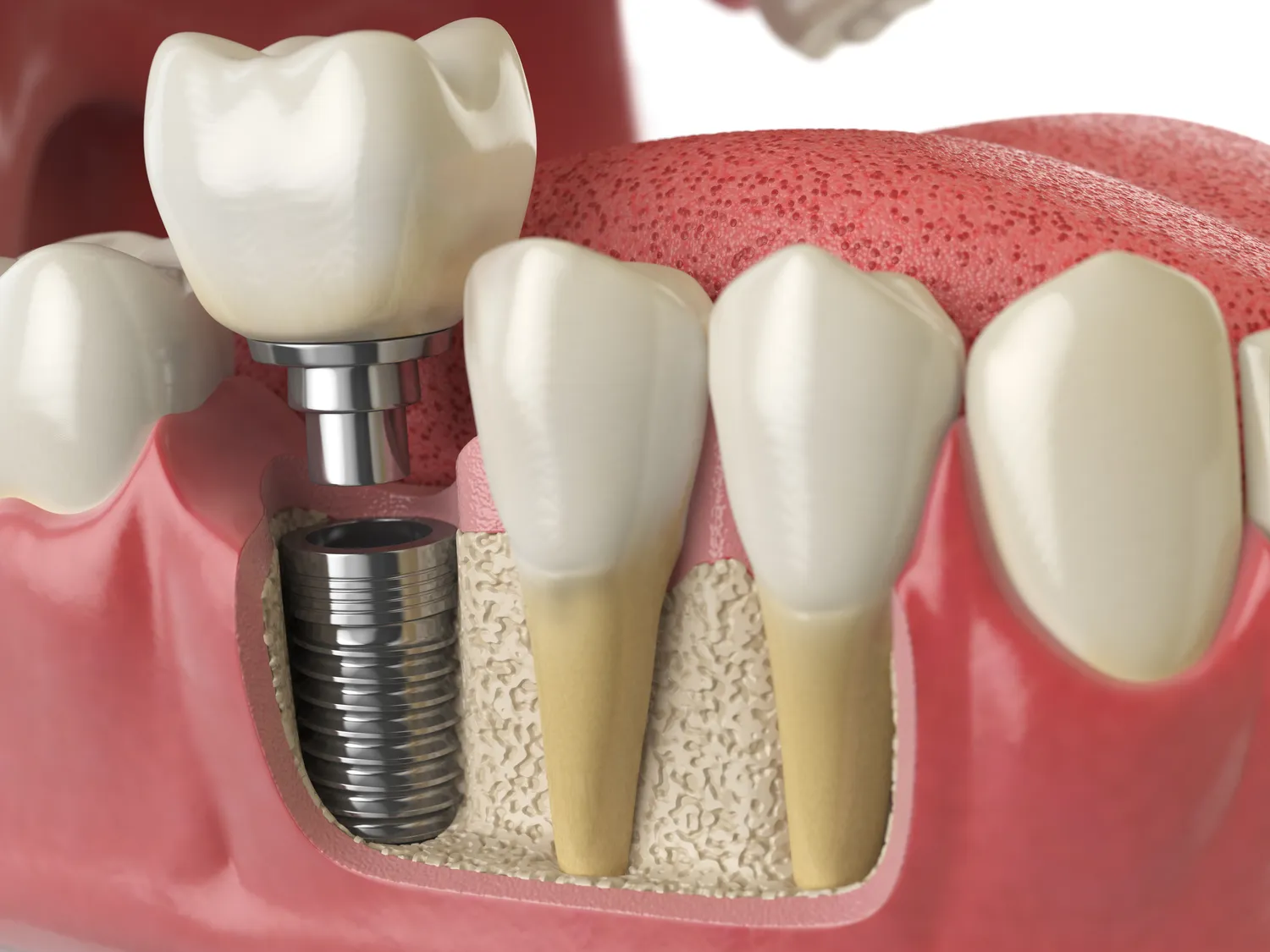 ile-kosztuje-jeden-implant-1