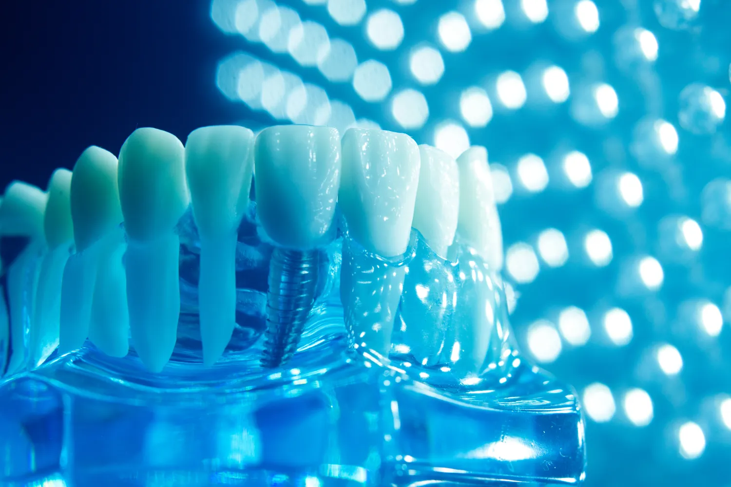 Implanty w jeden dzień Świnoujście