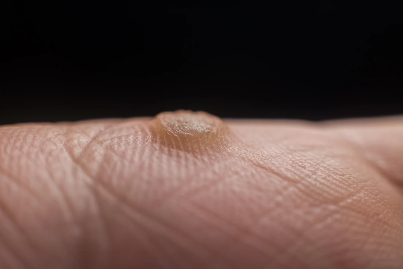 jak-domowym-sposobem-pozbyc-sie-kurzajki-1