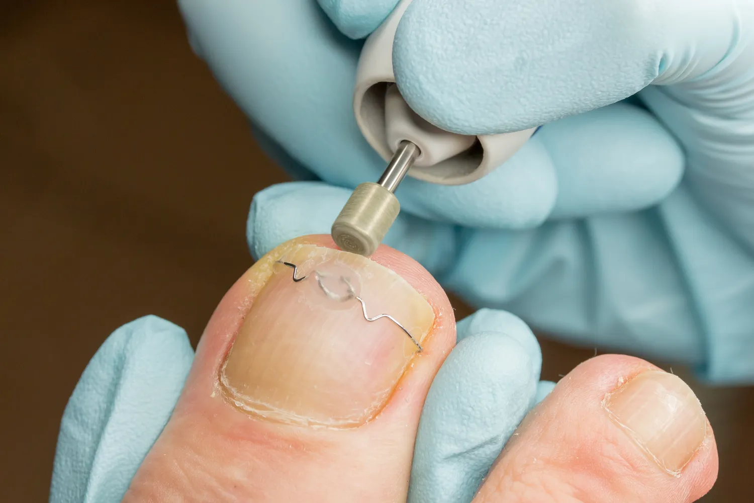 Podologia - pomaga rozwiązywać problemy zdrowotne stóp